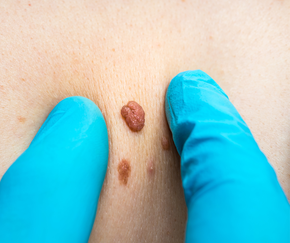 Cryotherapy Service - Wart, Verrucae and Skin Tag removal