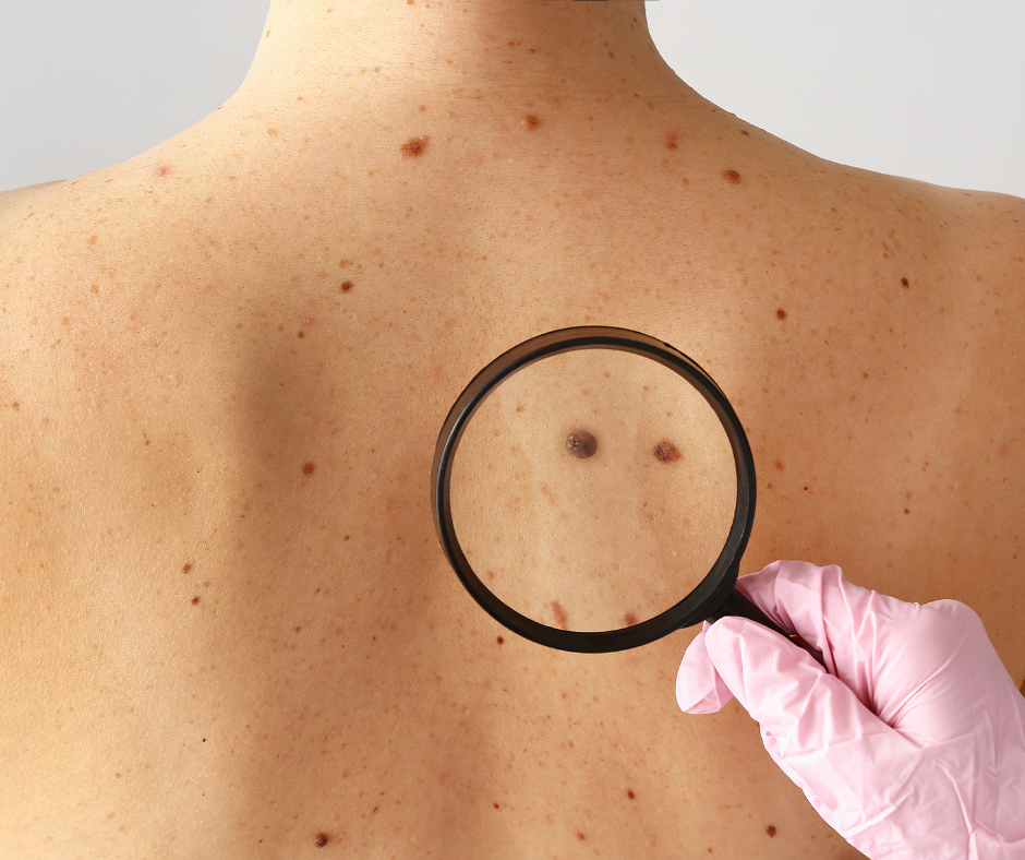 Mole Scanning: Early Detection Improves Outcomes And Saves Lives